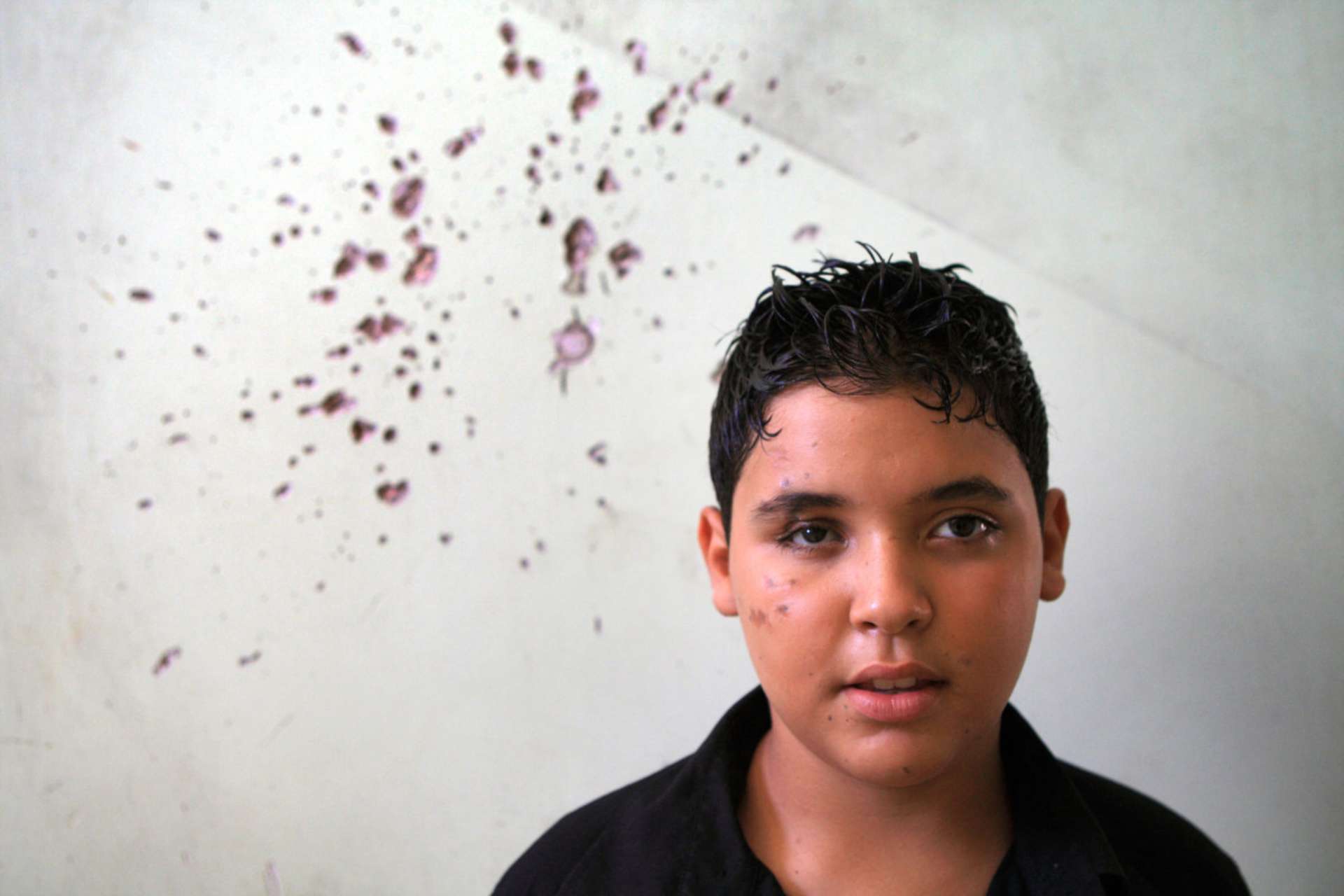 Mohamed wurde von Streumunition verletzt. Splitter trafen ihn im Gesicht und in der Hand. Hier ist er im Portrait vor einer weißen Wand zu sehen, die auch von Splittern der gleichen Streumunition beschädigt wurde.